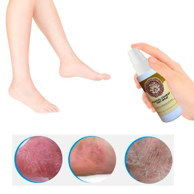 Spray de Tratamento Esterilizante para Pés- Fungal